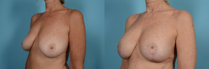 Before & After Breast Revision Surgery Case 582 View #2 View in Chicago, IL