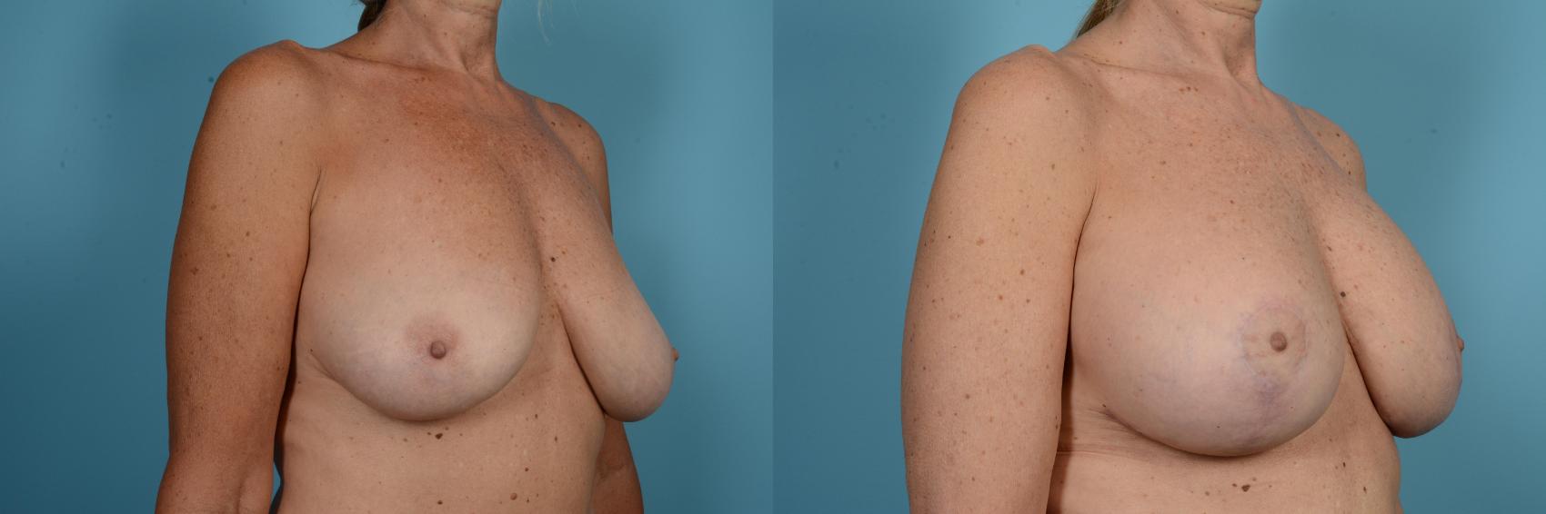 Before & After Breast Revision Surgery Case 582 View #3 View in Chicago, IL