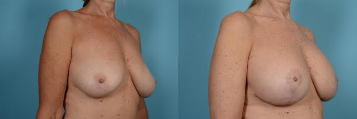 Before & After Breast Revision Surgery Case 582 View #3 View in Chicago, IL