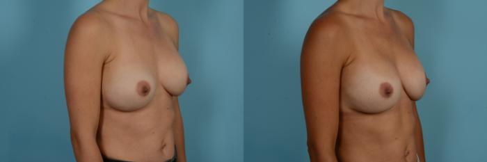 Dr. Sinno Breast Revision Surgery in Chicago, Illinois