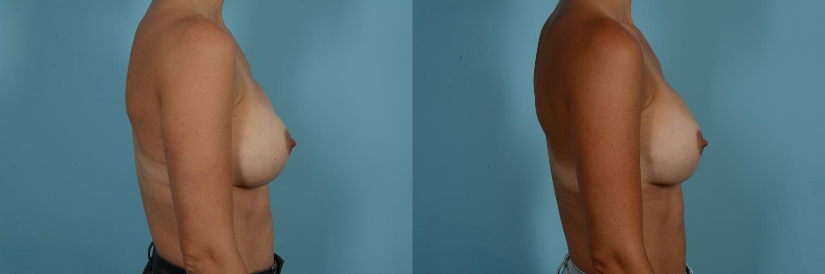 Dr. Sinno Breast Revision Surgery in Chicago, Illinois