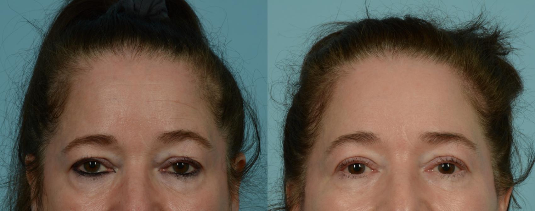 Before & After Brow Lift by Dr. Mustoe Case 1016 Front View in Chicago, IL