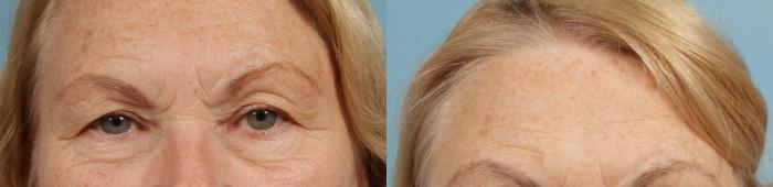 Before & After Brow Lift by Dr. Mustoe Case 131 Front View in Chicago, IL