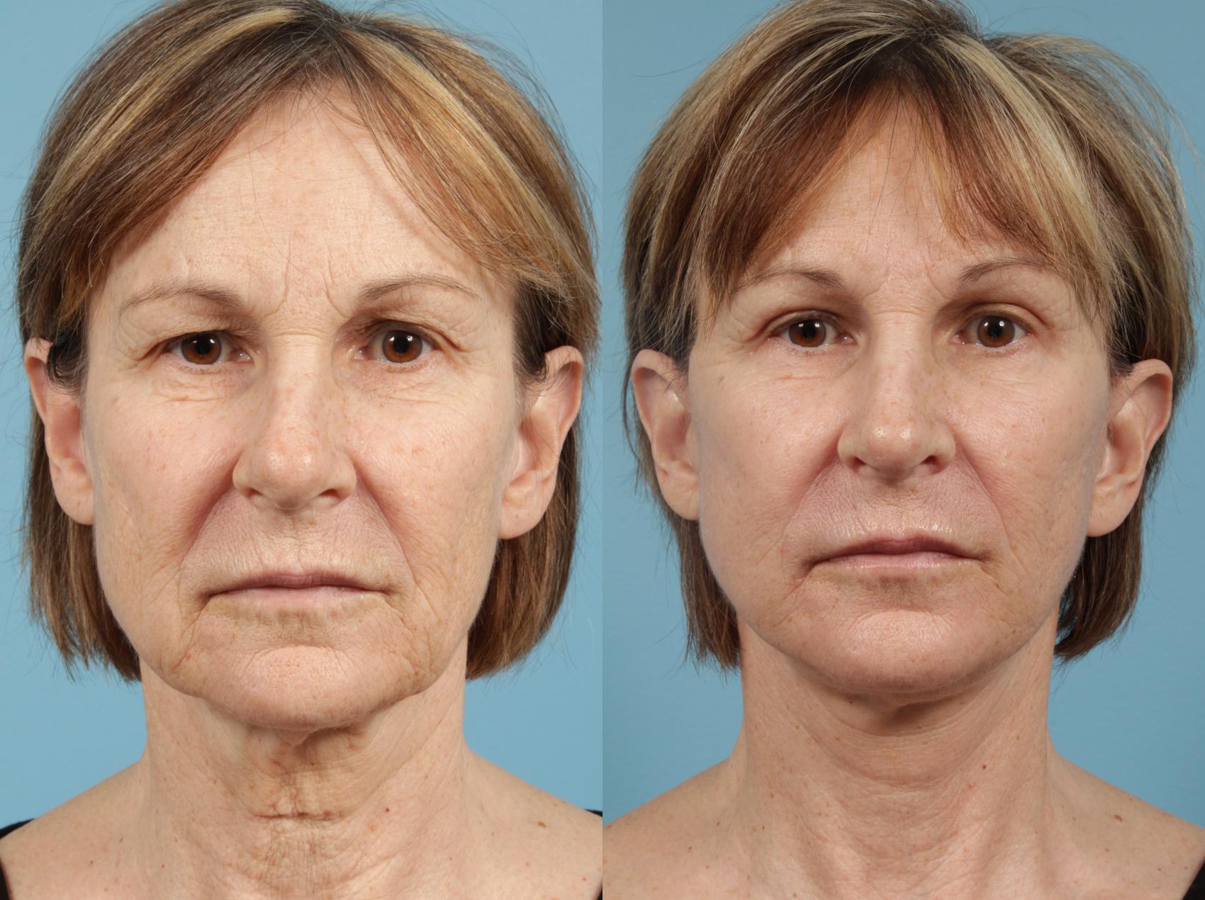 Before & After Brow Lift by Dr. Mustoe Case 153 Front View in Chicago, IL