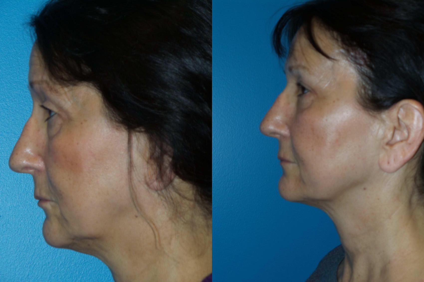 Before & After Brow Lift by Dr. Mustoe Case 403 View #1 View in Chicago, IL