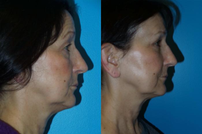 Before & After Blepharoplasty by Dr. Mustoe Case 403 View #2 View in Chicago, IL