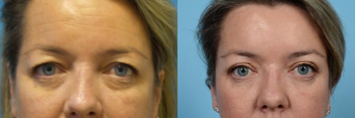 Before & After Brow Lift by Dr. Mustoe Case 442 View #2 View in Chicago, IL