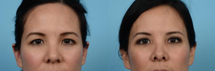Before & After Blepharoplasty by Dr. Mustoe Case 488 View #1 View in Chicago, IL