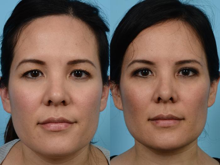 Before & After Blepharoplasty by Dr. Mustoe Case 488 View #2 View in Chicago, IL