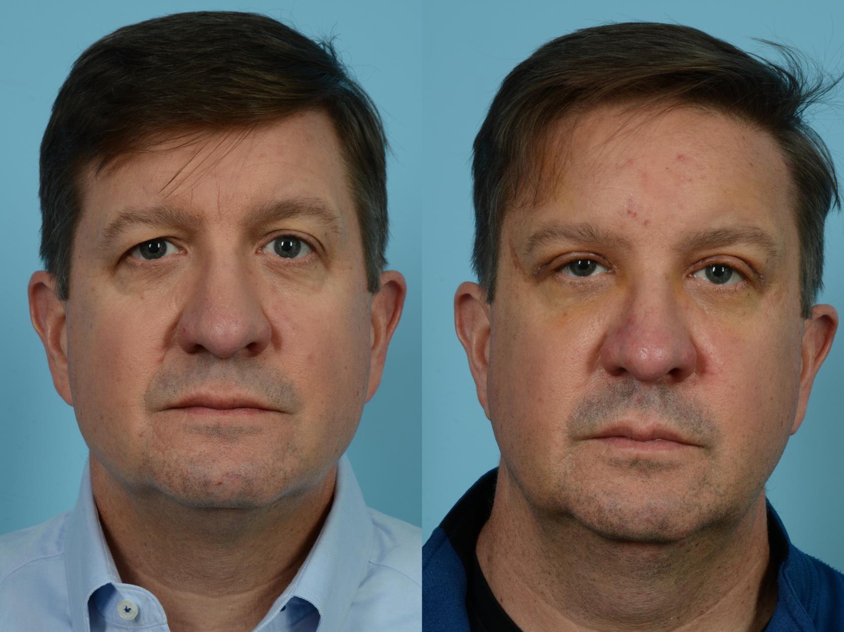 Before & After Brow Lift by Dr. Mustoe Case 849 1 week post-op View in Chicago, IL