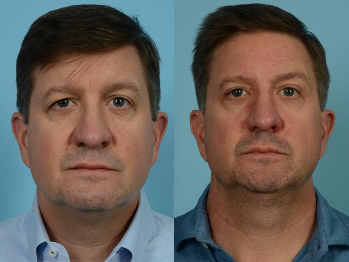 Before & After Blepharoplasty by Dr. Mustoe Case 849 18 months post-op View in Chicago, IL