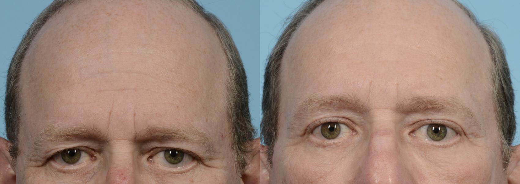 Before & After Brow Lift by Dr. Mustoe Case 950 Front View in Chicago, IL