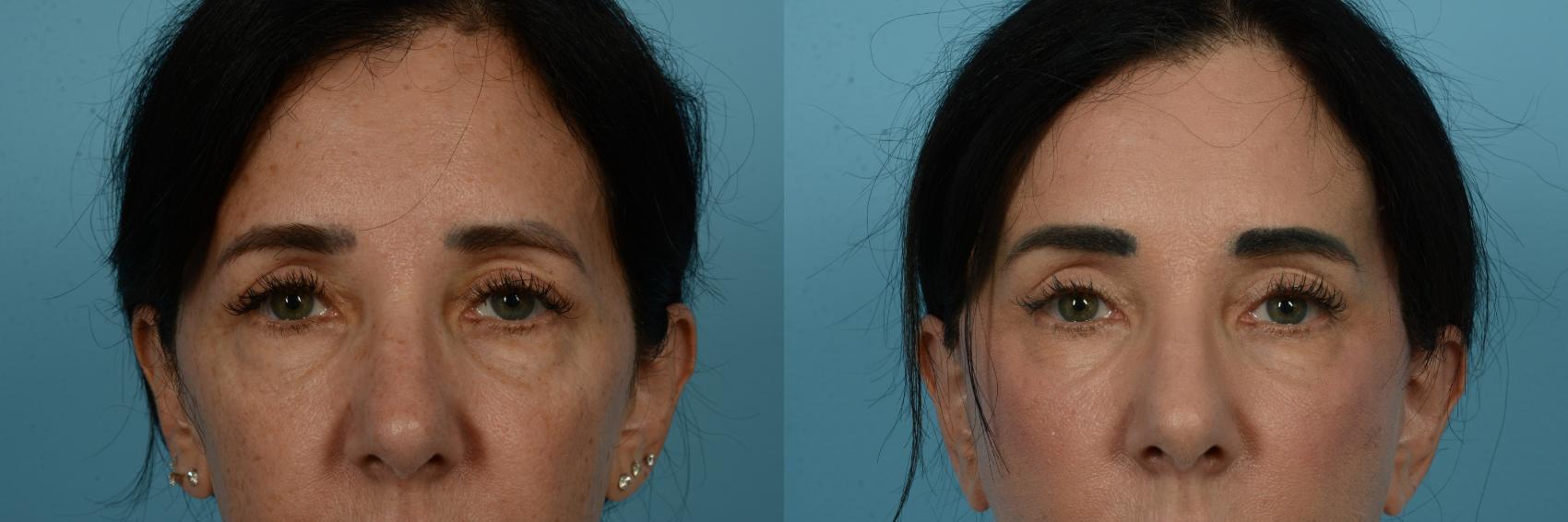 Before & After Brow Lift by Dr. Sinno Case 1111 Front View in Chicago, IL