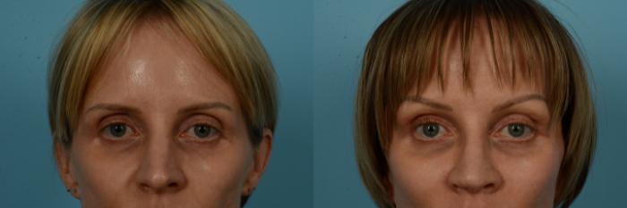 Before & After Brow Lift by Dr. Sinno Case 1120 Front View in Chicago, IL