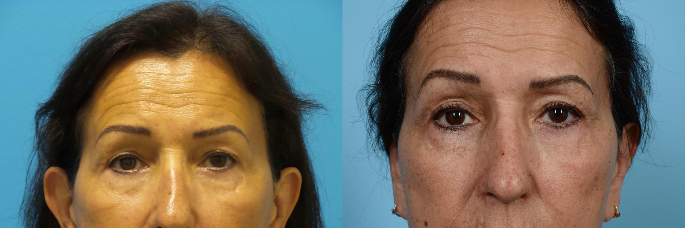 Before & After Brow Lift Case 402 View #1 View in Chicago, IL