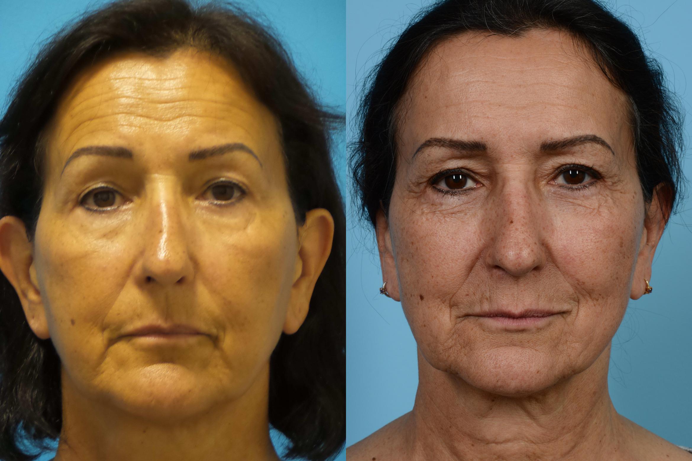 Brow Lift Before After Photos Patient 403 Chicago Il Tlkm Plastic Surgery