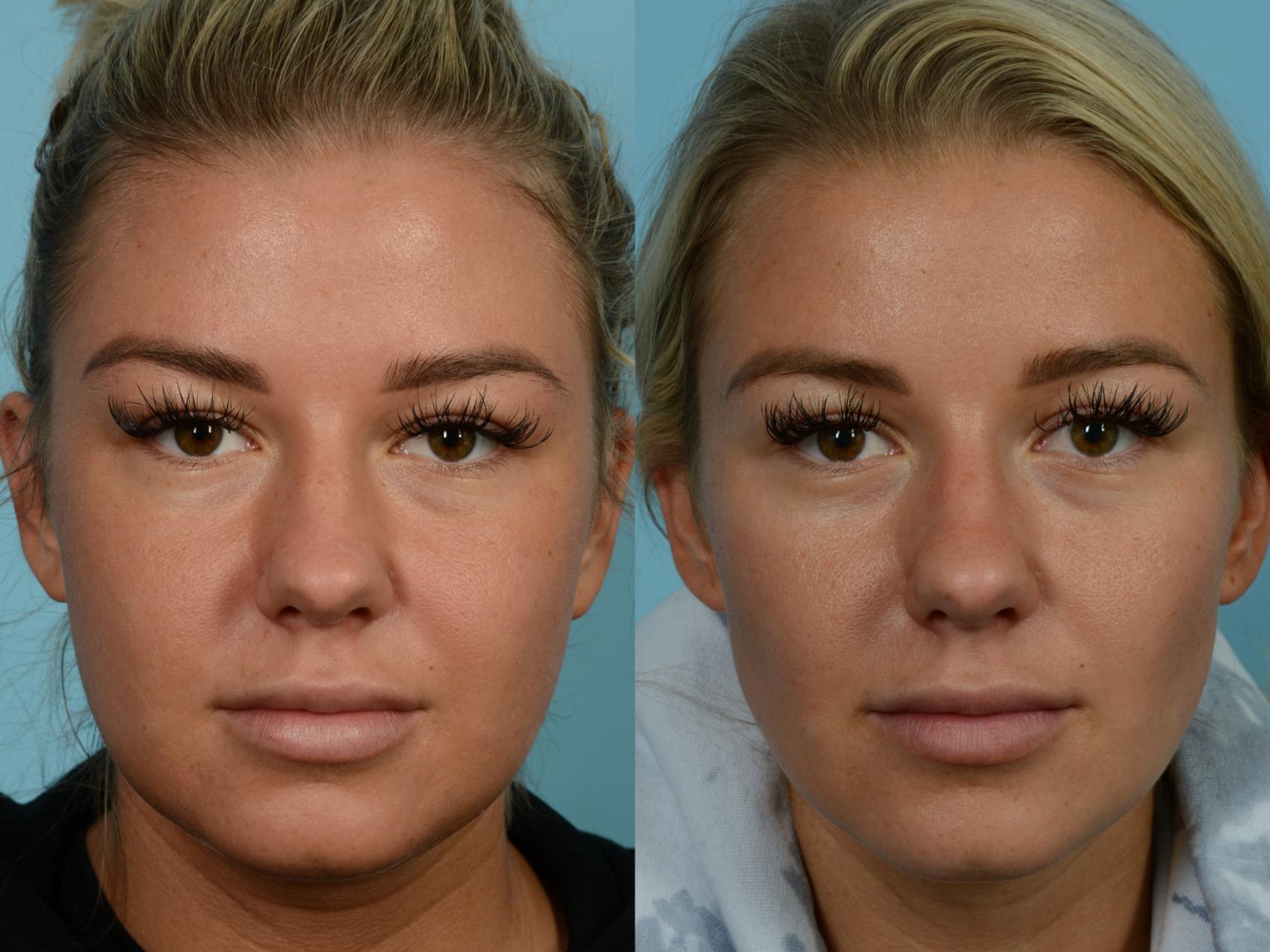 Dr. Sinno Buccal Fat Removal in Chicago, Illinois