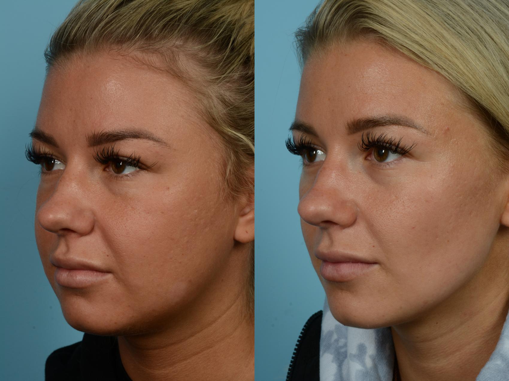 Buccal Fat Removal Before And After Pictures Case 714 Chicago IL 