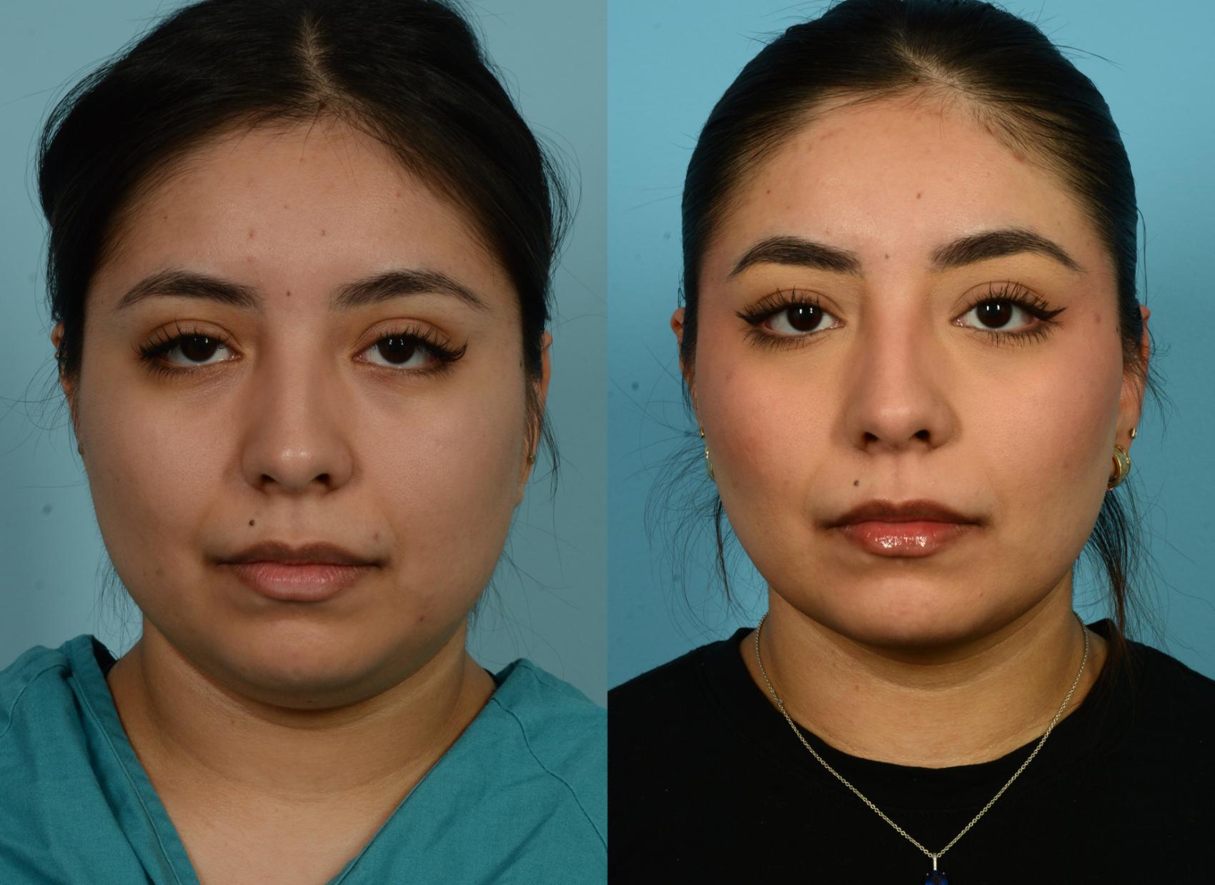 Before & After Buccal Fat Removal by Dr. Mustoe Case 1020 Front View in Chicago, IL