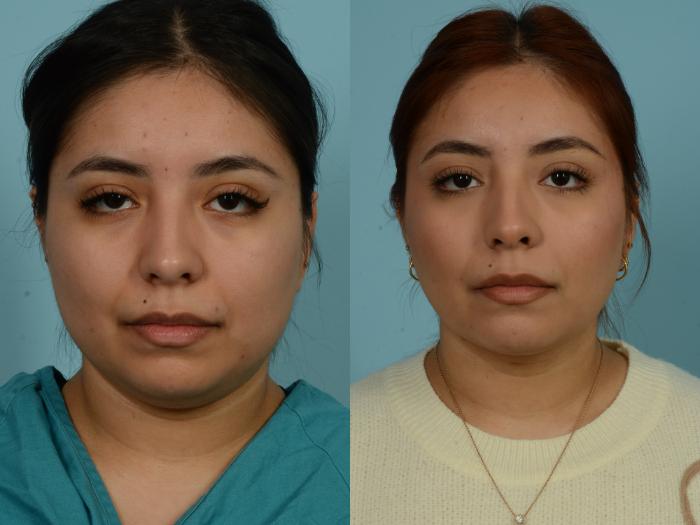 Before & After Buccal Fat Removal by Dr. Mustoe Case 1020 Front View in Chicago, IL