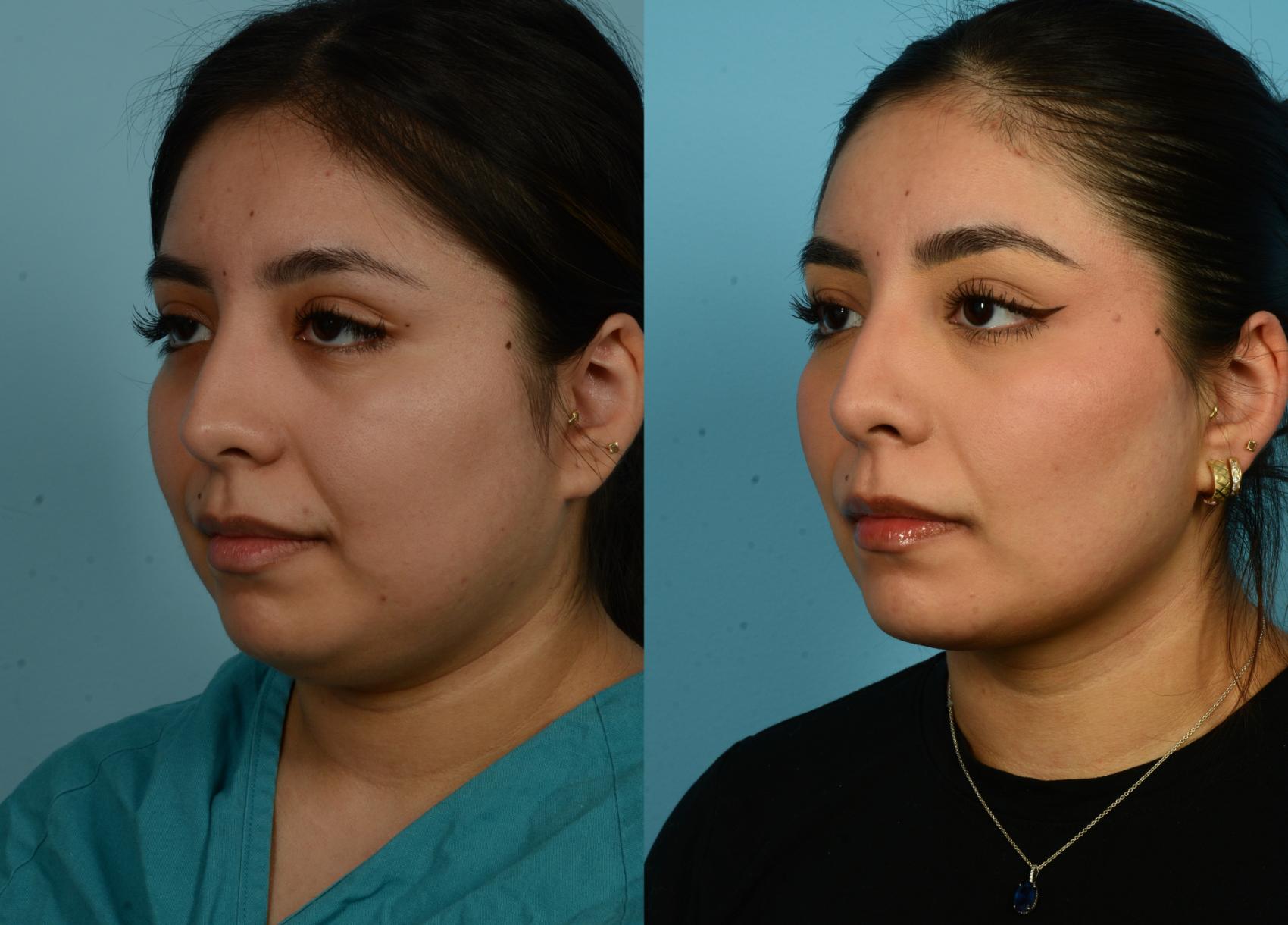 Before & After Buccal Fat Removal by Dr. Mustoe Case 1020 Left Oblique View in Chicago, IL