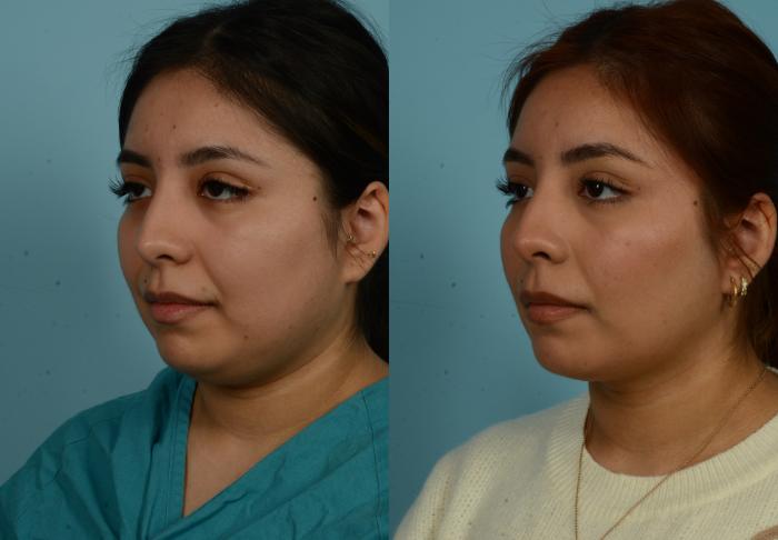 Before & After Buccal Fat Removal by Dr. Mustoe Case 1020 Left Oblique View in Chicago, IL