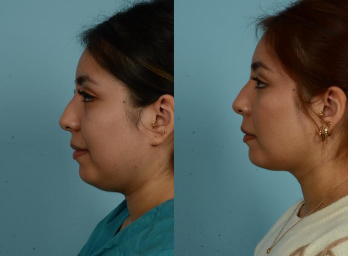 Before & After Buccal Fat Removal by Dr. Mustoe Case 1020 Left Side View in Chicago, IL