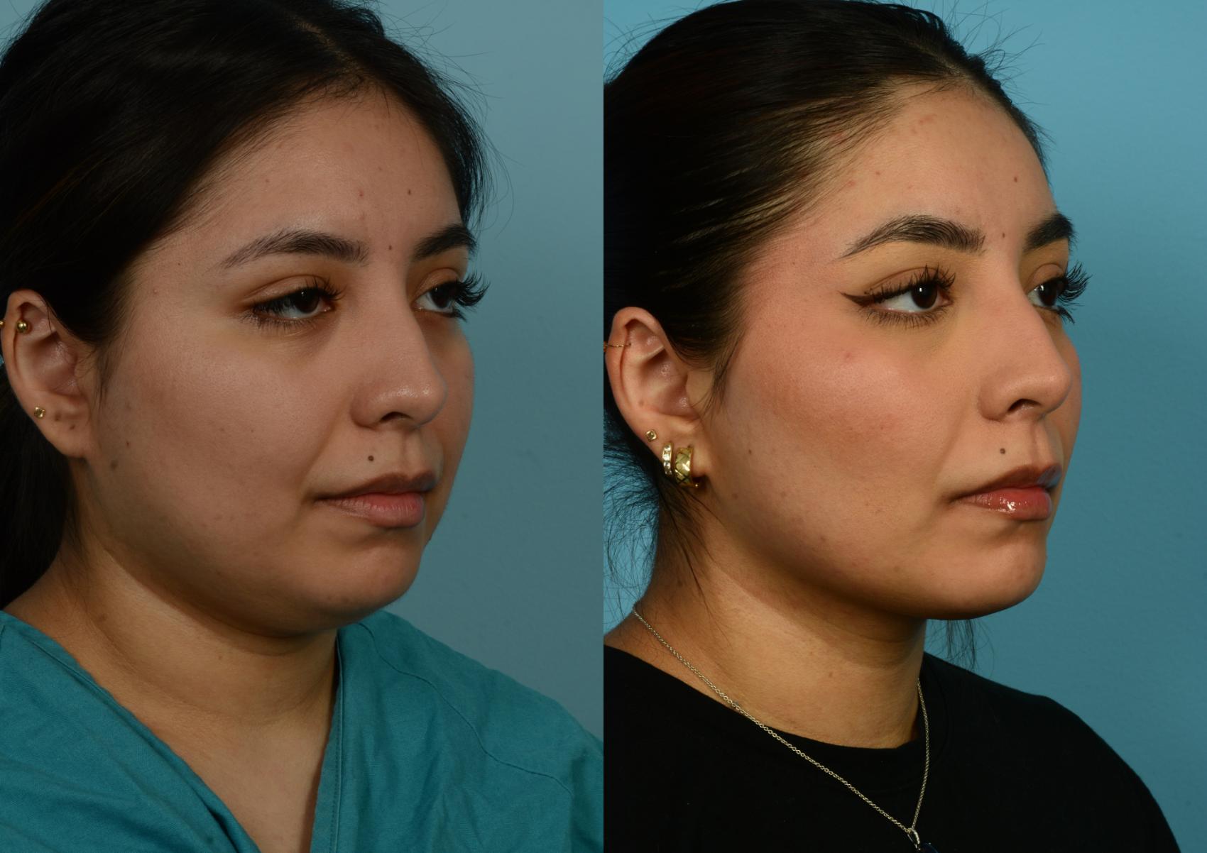 Before & After Buccal Fat Removal by Dr. Mustoe Case 1020 Right Oblique View in Chicago, IL
