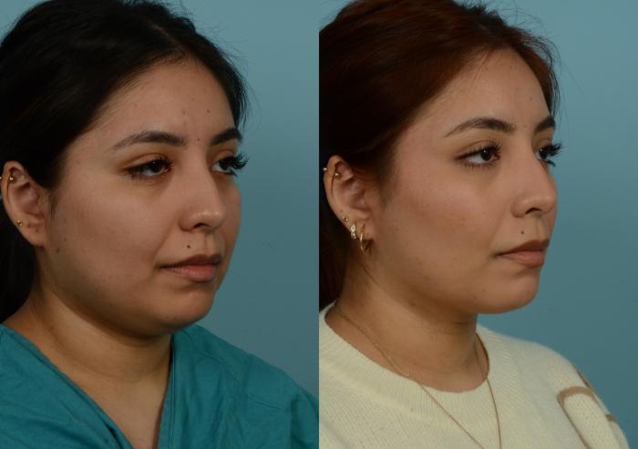 Before & After Buccal Fat Removal by Dr. Mustoe Case 1020 Right Oblique View in Chicago, IL