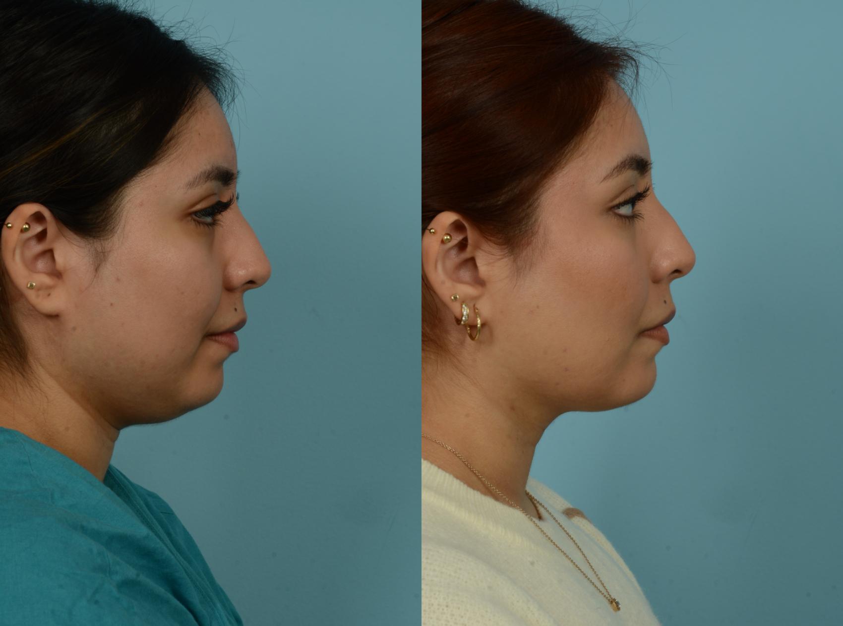 Before & After Buccal Fat Removal by Dr. Mustoe Case 1020 Right Side View in Chicago, IL