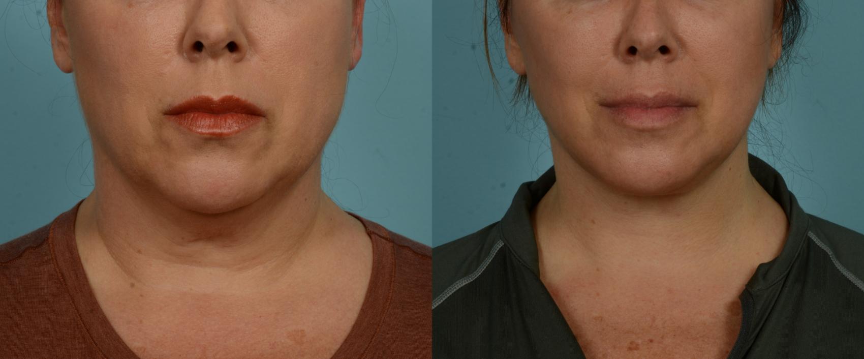 Before & After (cropped) Neck Lift by Dr. Mustoe Case 1003 Front View in Chicago, IL