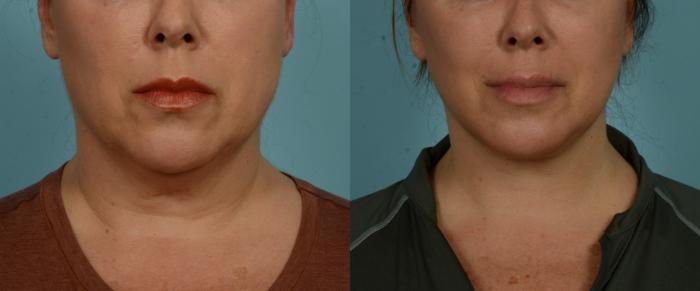 Before & After (cropped) Neck Lift by Dr. Mustoe Case 1003 Front View in Chicago, IL