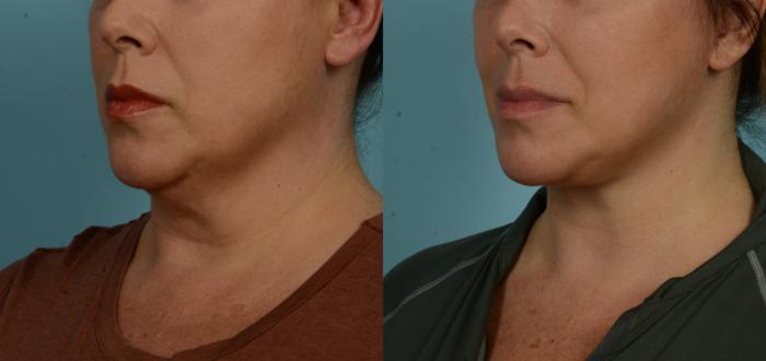 Before & After (cropped) Neck Lift by Dr. Mustoe Case 1003 Left Oblique View in Chicago, IL