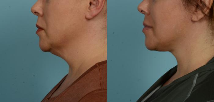 Before & After (cropped) Neck Lift by Dr. Mustoe Case 1003 Left Side View in Chicago, IL