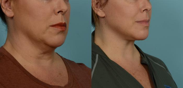 Before & After (cropped) Neck Lift by Dr. Mustoe Case 1003 Right Oblique View in Chicago, IL