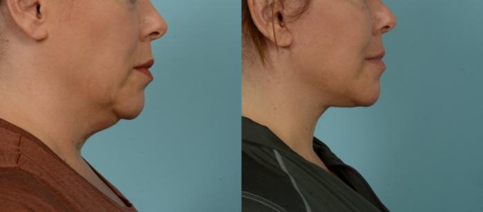 Before & After (cropped) Neck Lift by Dr. Mustoe Case 1003 Right Side View in Chicago, IL