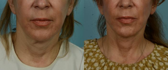 Before & After (cropped) Neck Lift by Dr. Mustoe Case 1005 Front View in Chicago, IL