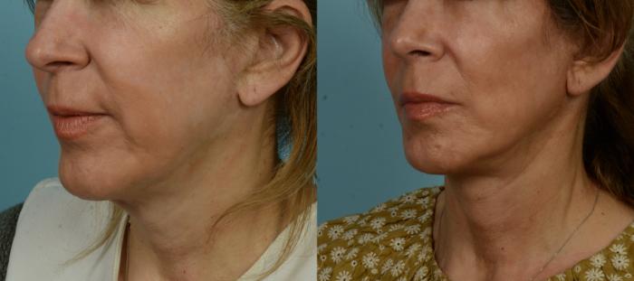 Before & After (cropped) Neck Lift by Dr. Mustoe Case 1005 Left Oblique View in Chicago, IL