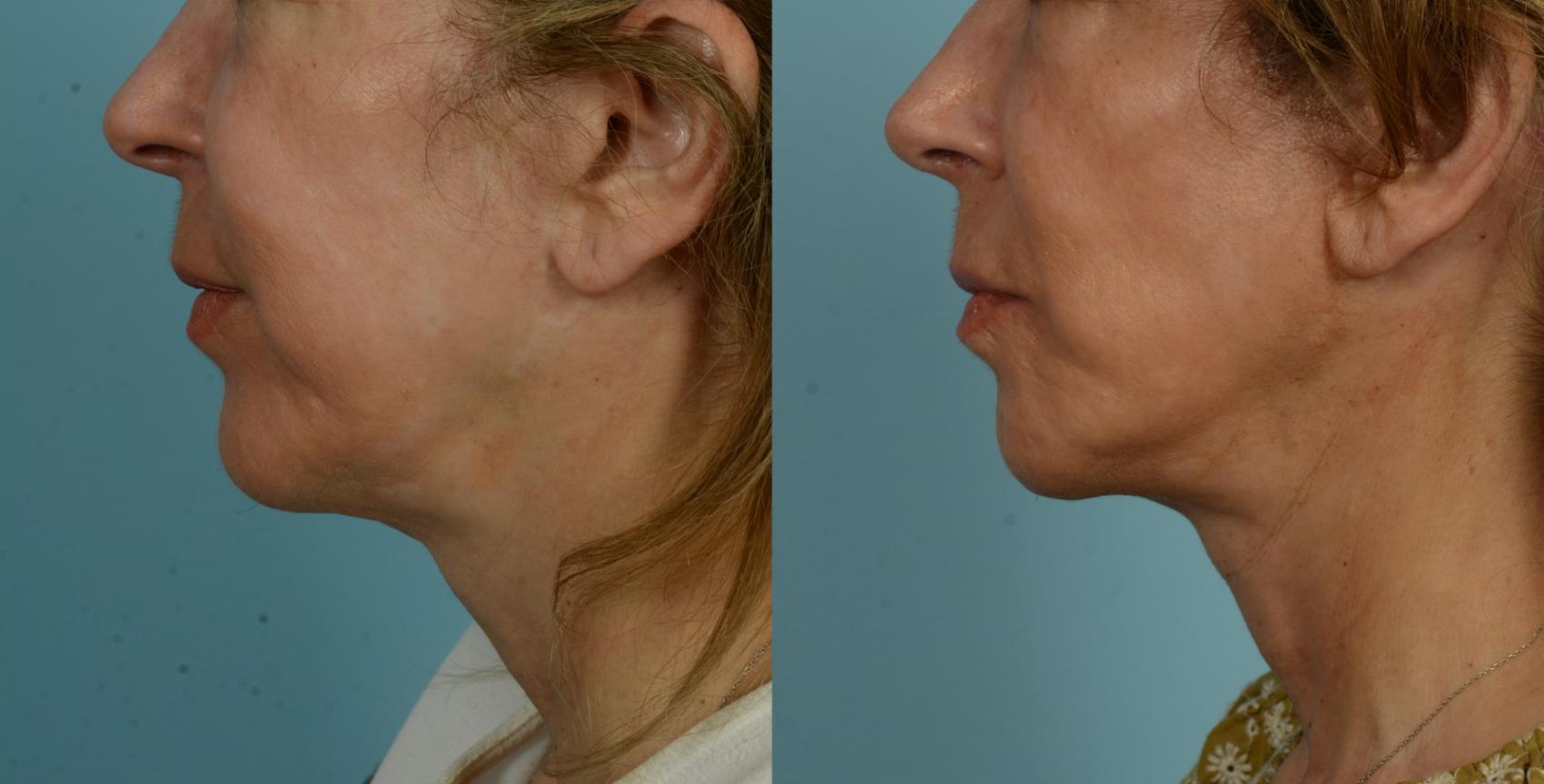 Before & After (cropped) Neck Lift by Dr. Mustoe Case 1005 Left Side View in Chicago, IL