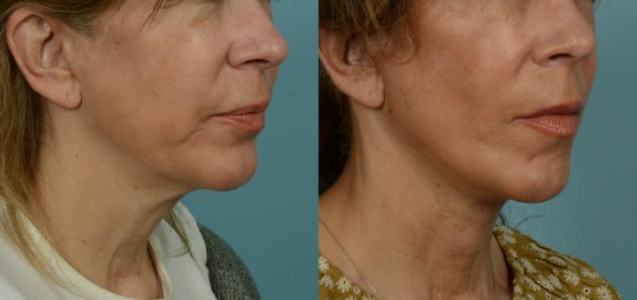 Before & After (cropped) Neck Lift by Dr. Mustoe Case 1005 Right Oblique View in Chicago, IL