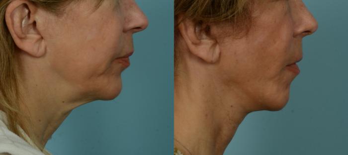 Before & After (cropped) Neck Lift by Dr. Mustoe Case 1005 Right Side View in Chicago, IL