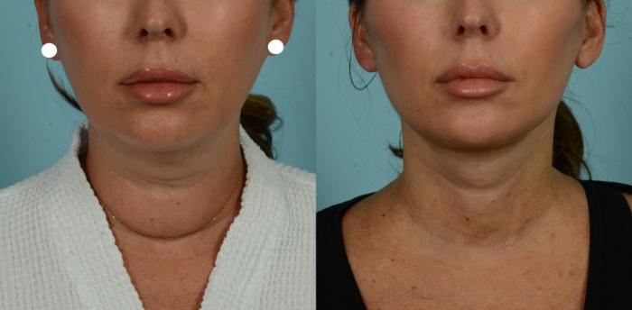 Before & After (cropped) Neck Lift by Dr. Mustoe Case 1012 Front View in Chicago, IL