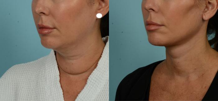 Before & After (cropped) Neck Lift by Dr. Mustoe Case 1012 Left Oblique View in Chicago, IL