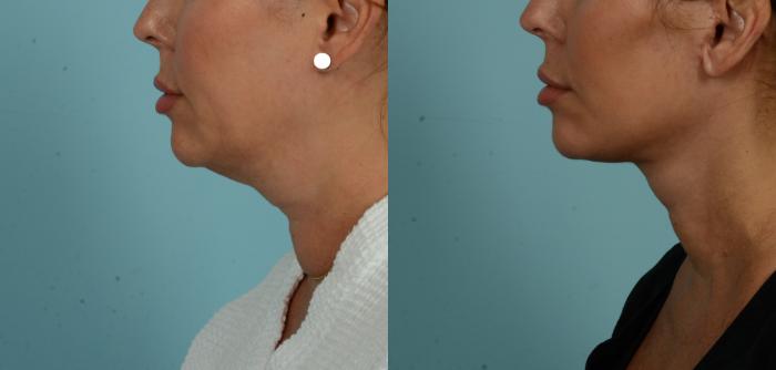 Before & After (cropped) Neck Lift by Dr. Mustoe Case 1012 Left Side View in Chicago, IL