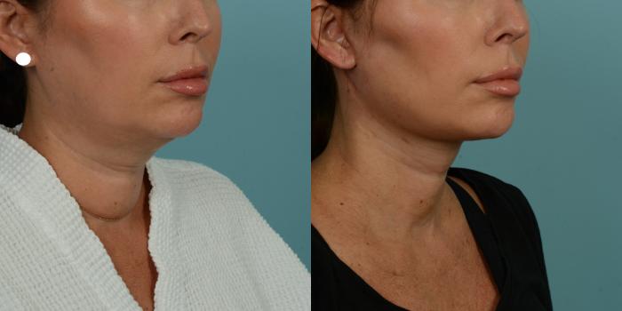 Before & After (cropped) Neck Lift by Dr. Mustoe Case 1012 Right Oblique View in Chicago, IL