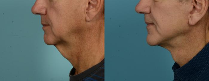 Before & After (cropped) Neck Lift by Dr. Mustoe Case 1082 Left Side View in Chicago, IL