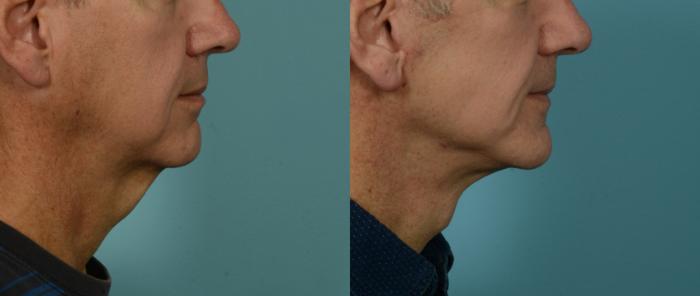 Before & After (cropped) Neck Lift by Dr. Mustoe Case 1082 Right Side View in Chicago, IL