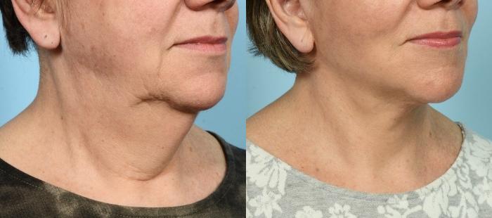 Before & After (cropped) Neck Lift by Dr. Mustoe Case 896 Right Oblique View in Chicago, IL