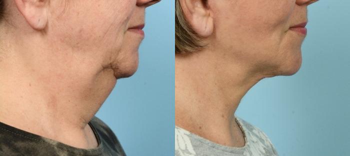 Before & After (cropped) Neck Lift by Dr. Mustoe Case 896 Right Side View in Chicago, IL