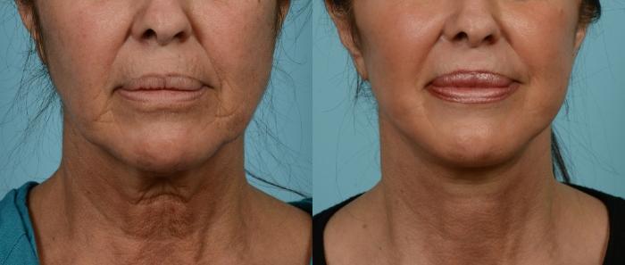 Before & After (cropped) Neck Lift by Dr. Mustoe Case 975 Front View in Chicago, IL